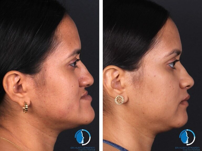 Instagram post from dr.hugo_bucomaxilo. This post is in position 1.